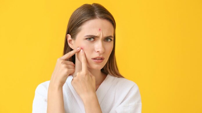 What is acne? All you need to know about the stubborn breakouts