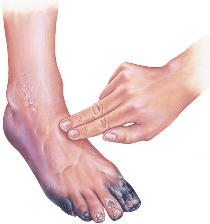 Gangrene Foot: Understanding the Causes and Prevention Strategies