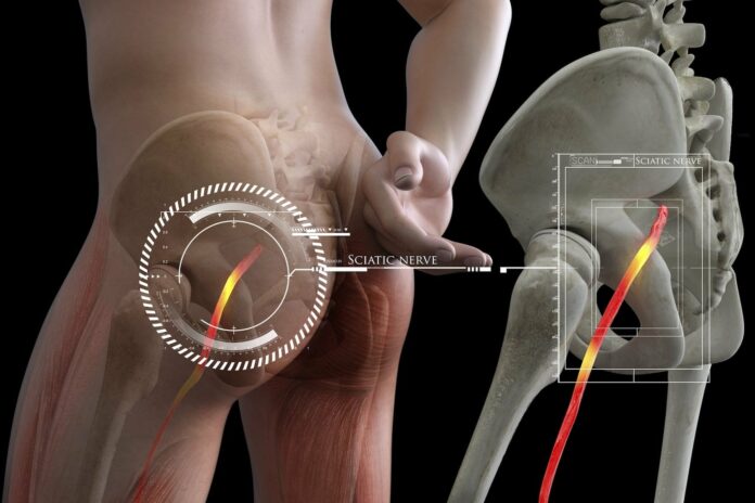 Sciatica - Effects and Management