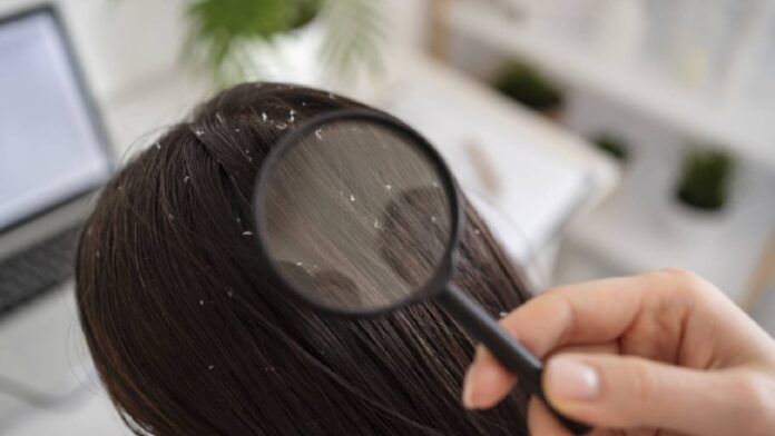 What causes dandruff? How to prevent and treat these white flakes of skin