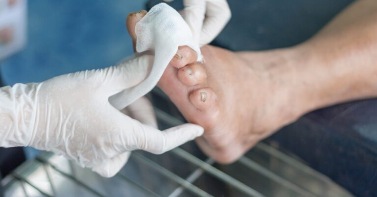 Diabetic Charcot Foot: Causes, Diagnosis, and Treatment