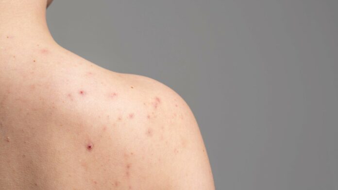 How to get rid of shoulder acne: 5 home remedies worth a try