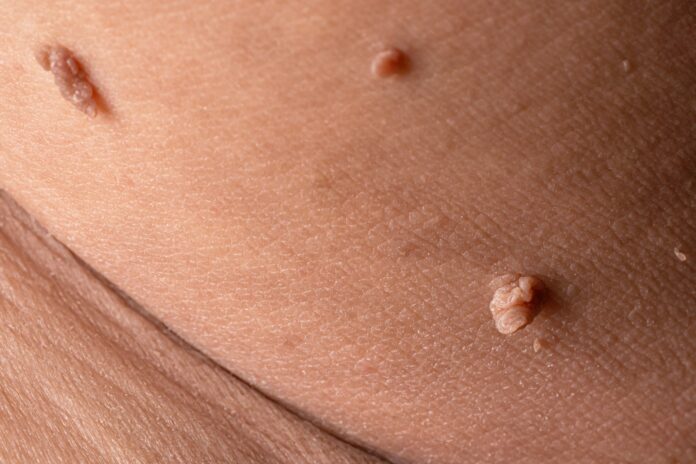 Diabetes and Skin Tags