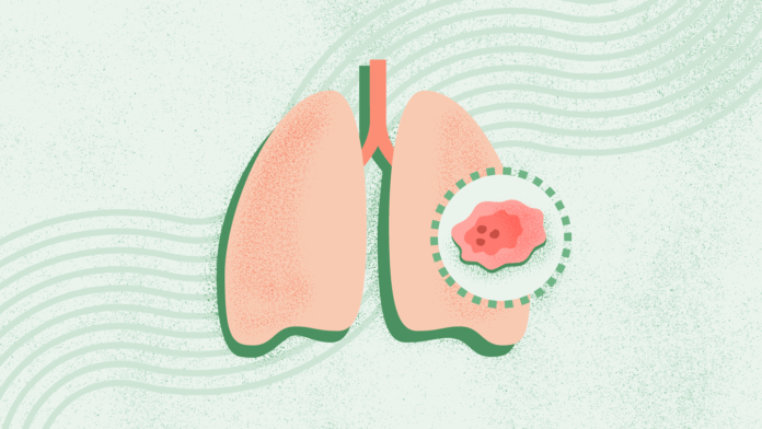 What Is Lung Cancer?