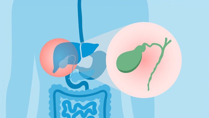 Primary Sclerosing Cholangitis and Ulcerative Colitis: What to Know About This Liver Complication
