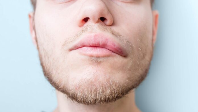 Is It Hereditary Angioedema or Allergic Angioedema?