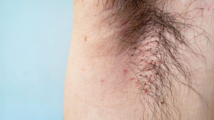 Everything You Need to Know About Body Lice, Including Symptoms and Treatments