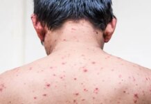 Chickenpox in Adults: Risk Factors, Symptoms, Complications, Treatment Chickenpox in Adults: Risk Factors, Symptoms, Complications, Treatment