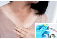 Dark patches on your child’s neck? Doctor says it may be a sign of insulin resistance Dark patches on your child’s neck? Doctor says it may be a sign of insulin resistance