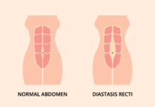 How To Prevent and Treat Diastasis Recti: Key Exercises and Tips split abs after birth
