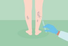 What Is Sclerotherapy for Spider Veins and Varicose Veins? What Is Sclerotherapy for Spider Veins and Varicose Veins?