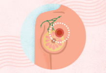 What Is Breast Cancer? Symptoms, Causes, Diagnosis, Treatment, and Prevention What Is Breast Cancer? Symptoms, Causes, Diagnosis, Treatment, and Prevention