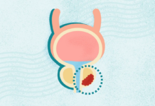 What Is Prostate Cancer? Symptoms, Stages, Diagnosis, Treatment, and More What Is Prostate Cancer? Symptoms, Stages, Diagnosis, Treatment, and More