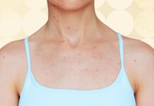5 Places Body Acne Can Show Up and What to Do About It 5 Places Body Acne Can Show Up and What to Do About It