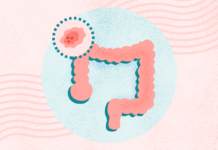 What Is Colon and Rectal Cancer? Symptoms, Causes, Diagnosis, Treatment, and Prevention What Is Colon and Rectal Cancer? Symptoms, Causes, Diagnosis, Treatment, and Prevention